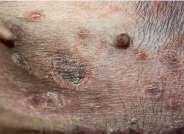 07-07-epidermal-colarette.jpg